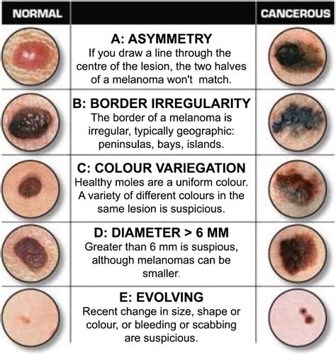 Types of Moles: Noncancerous and Cancerous Pictures